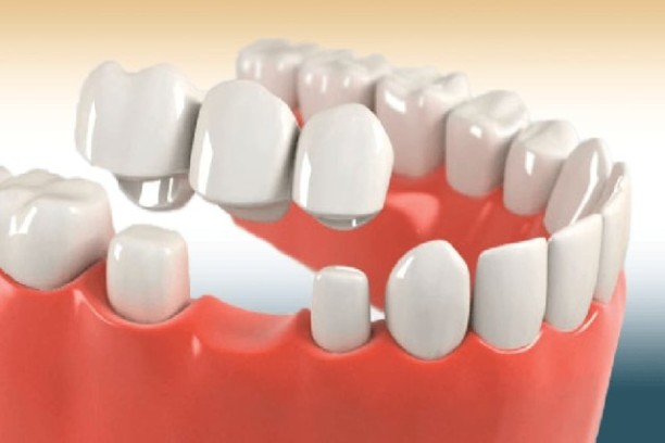 Dental-Crowns-1 (1) (1)