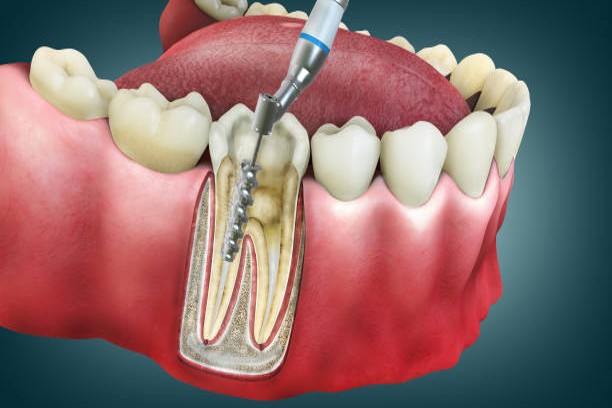 Root canal treatment new (1)