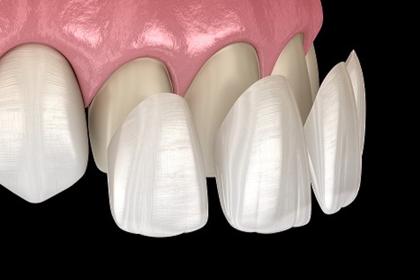 Veneers (1)