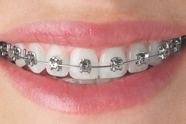 metallic-braces (1)